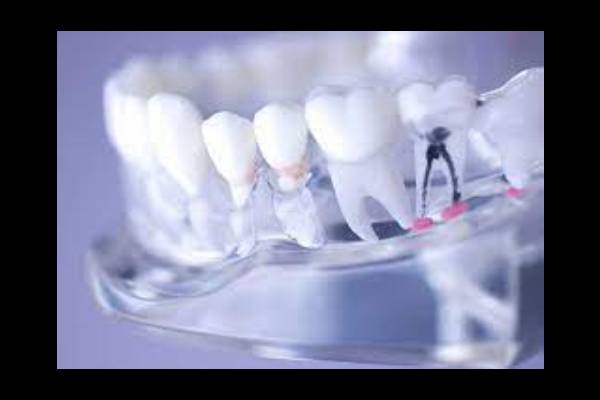 Root Canal Treatment